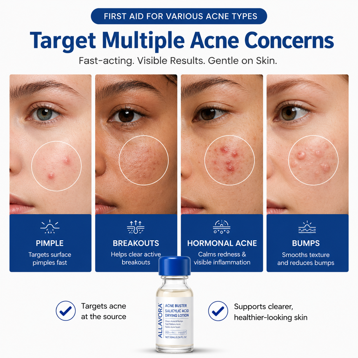 Allavora Overnight Acne Treatment