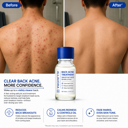 Allavora Back Acne Treatment