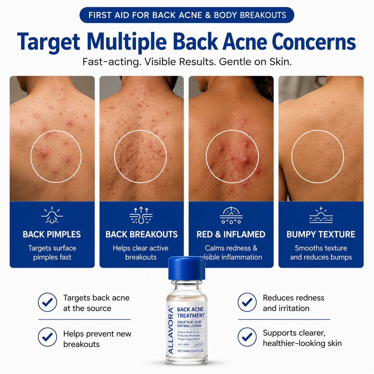 Allavora Back Acne Treatment