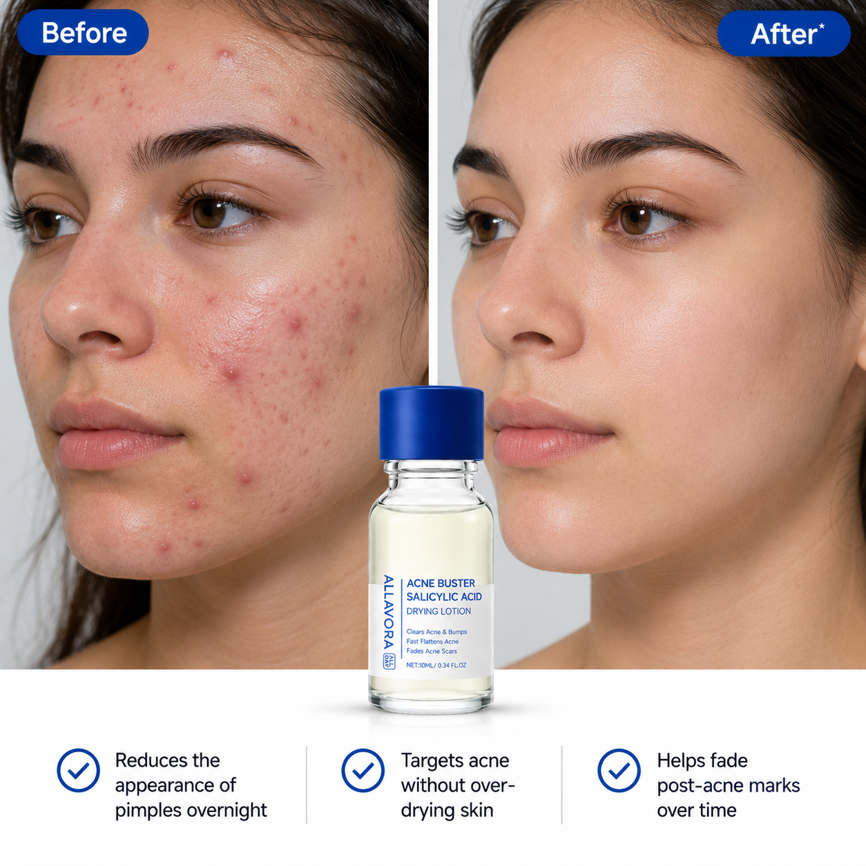 Allavora Overnight Acne Treatment